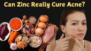 zinc cure acne